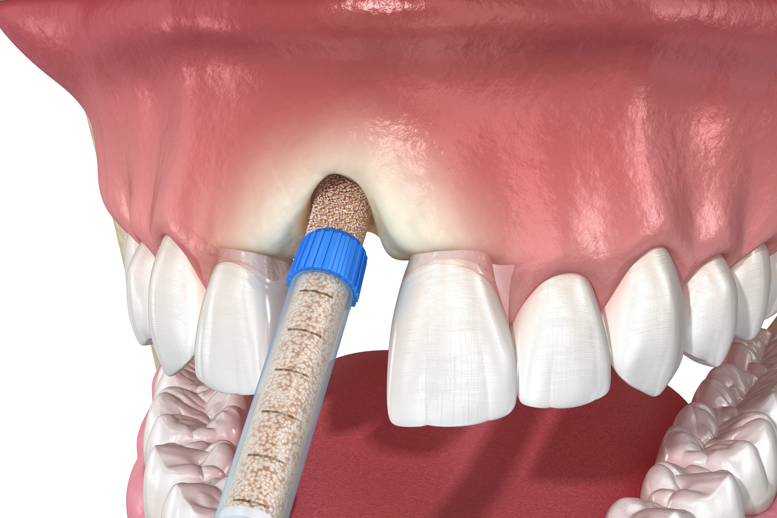 Carolina Beach Bone Grafting